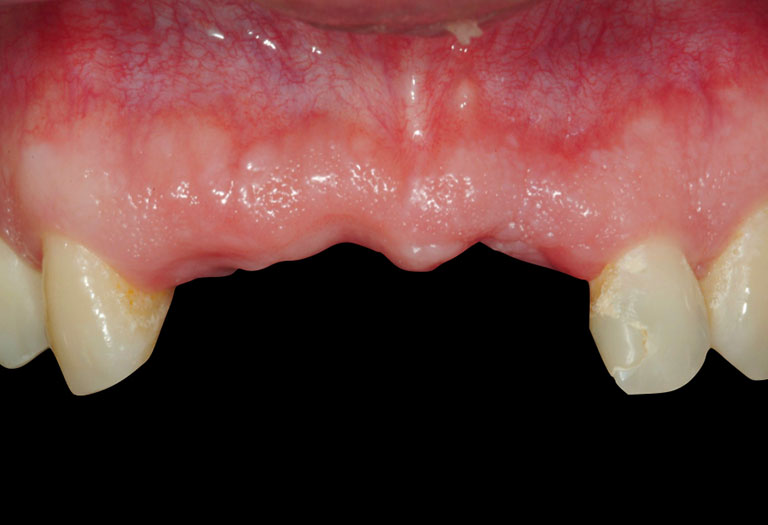 implants dentaire en suisse implants dentaire en suisse