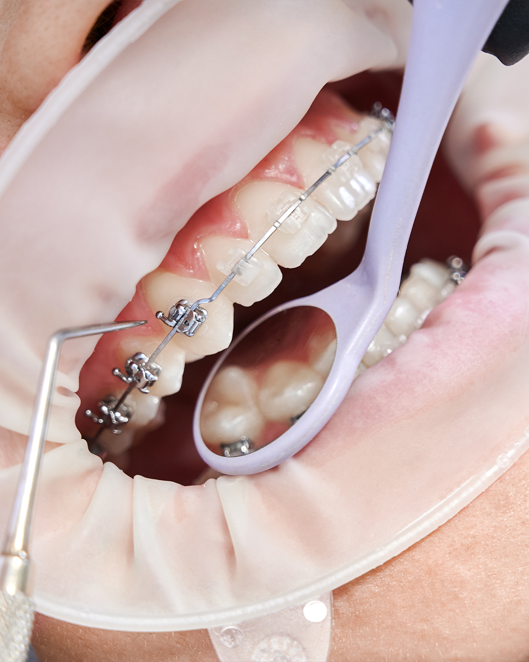 orthodontiste geneve orthodontiste geneve