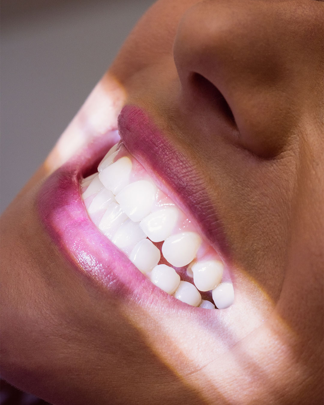 blanchiment dentaire a geneve cabinet dentiste