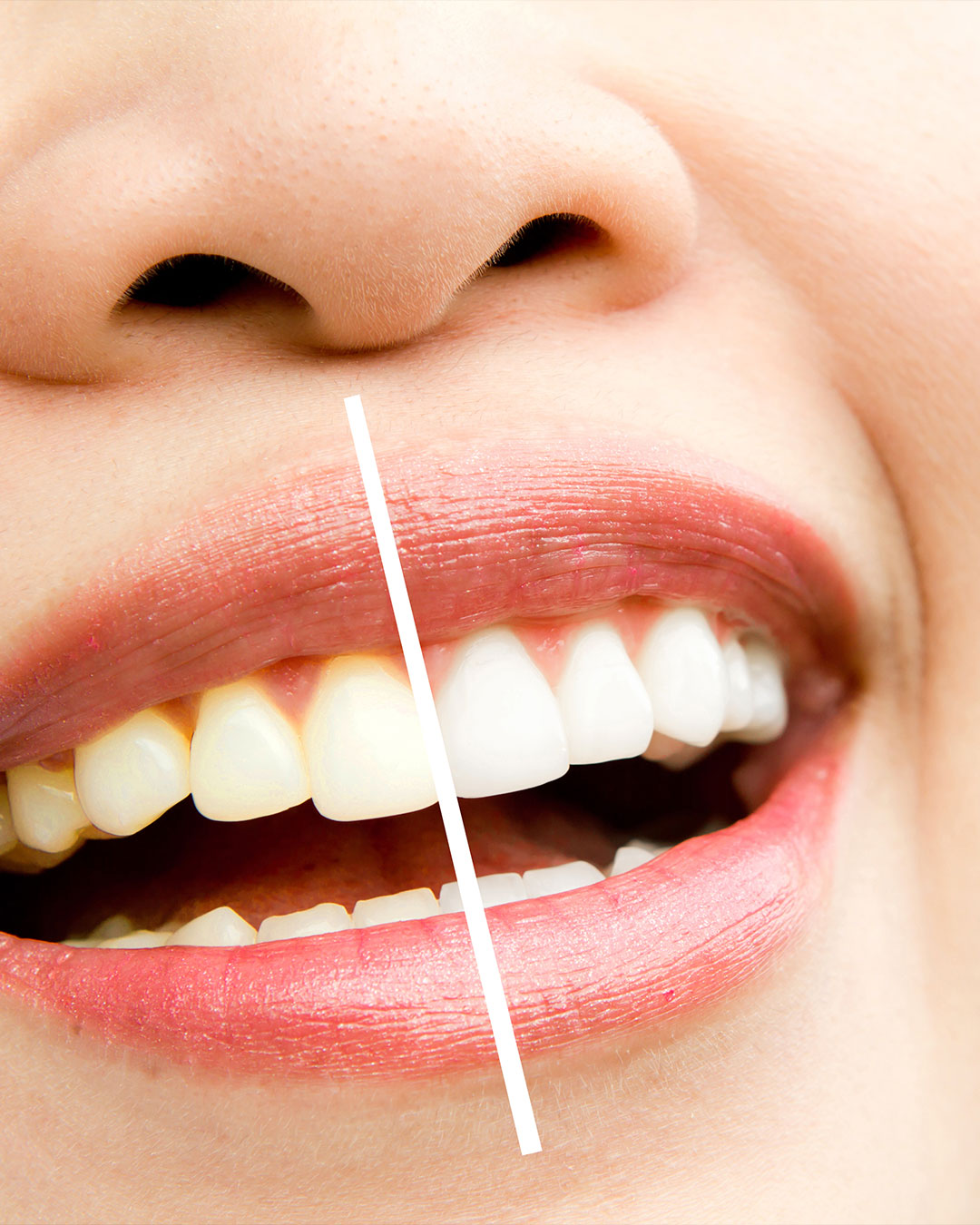 blanchiment dentaire geneve cabinet dentaire